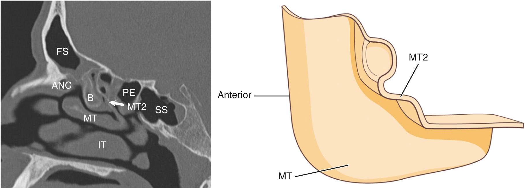 Fig. 44.4, The oblique, second part of the middle turbinate (MT2) attaches to the lamina papyracea via the basal lamella, separating the anterior ethmoidal (B) from the posterior ethmoidal (PE) cells. This part lies in a coronal/frontal plane and is best viewed on a sagittal view computed tomography scan. ANC, agger nasi cell; FS, Frontal sinus; IT, inferior turbinate; MT, middle turbinate; SS, sphenoid sinus.