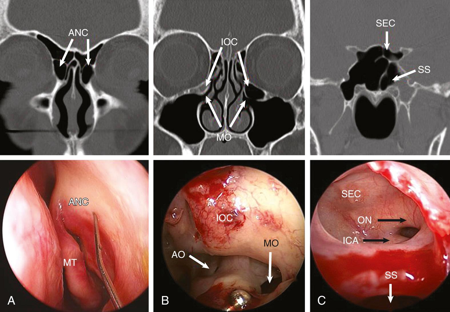 Fig. 44.5, Ethmoidal cells. Top row shows computed tomography (CT) scan with corresponding endoscopic view below. (A) The agger nasi cell (ANC) is the most anterior cell seen on a coronal CT scan and anterior to the middle turbinate (MT) . Endoscopically it is seen as a bulge on the middle turbinate attachment and may narrow the superior ethmoidal infundibulum. (B) Coronal CT section shows bilateral infraorbital ethmoidal cell ( IOC , Haller cell) narrowing the inferior ethmoidal infundibulum and attaching laterally to the infraorbital canal. The maxillary sinus opens into the inferior part of the infundibulum at a 45-degree angle. Endoscopic view of the left infundibulum after uncinectomy shows the infraorbital ethmoidal cell narrowing the inferior infundibulum and potentially obstructing drainage of the natural maxillary ostium (MO) . The natural maxillary ostium is elliptically shaped and opens into the floor of the infundibulum at a 45-degree angle, not directly into the lateral wall. Accessory ostia (AO) are usually circular and are present here in the posterior fontanelle. (C) The sphenoethmoidal cell (SEC) , or Onodi cell, is a posterior ethmoidal cell that is lateral and superior to the sphenoid sinus (SS) , which is usually smaller, pushed medially and inferiorly. The figures show arrows pointing to a left SEC on coronal and sagittal CT cuts. The endoscopic image demonstrates the relationship of the SEC to the SS and shows the optic nerve (ON) and internal carotid artery (ICA) lying in relation to the SEC lateral wall.