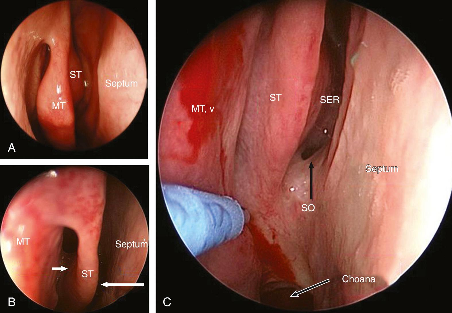 Fig. 44.6, Endoscopic transnasal view of the right superior turbinate (ST) and superior meatus, showing progressively closer posterior views in (A) through (C). Anteriorly, the superior turbinate shares a skull base attachment with the middle turbinate (MT) and runs in a sagittal plane like the middle turbinate. The superior meatus ( small arrow in B) is, therefore, posterior to the medial half of the middle portion of the basal lamella of the middle turbinate. Posterior ethmoidal cells open into the superior meatus. Inferiorly, the superior turbinate forms the lateral wall of the sphenoethmoidal recess ( SER , large arrow in B), which lies between the septum medially and the superior meatus laterally. The sphenoid ostium (SO) opens into the sphenoethmoidal recess. MT,v, middle turbinate, vertical part.