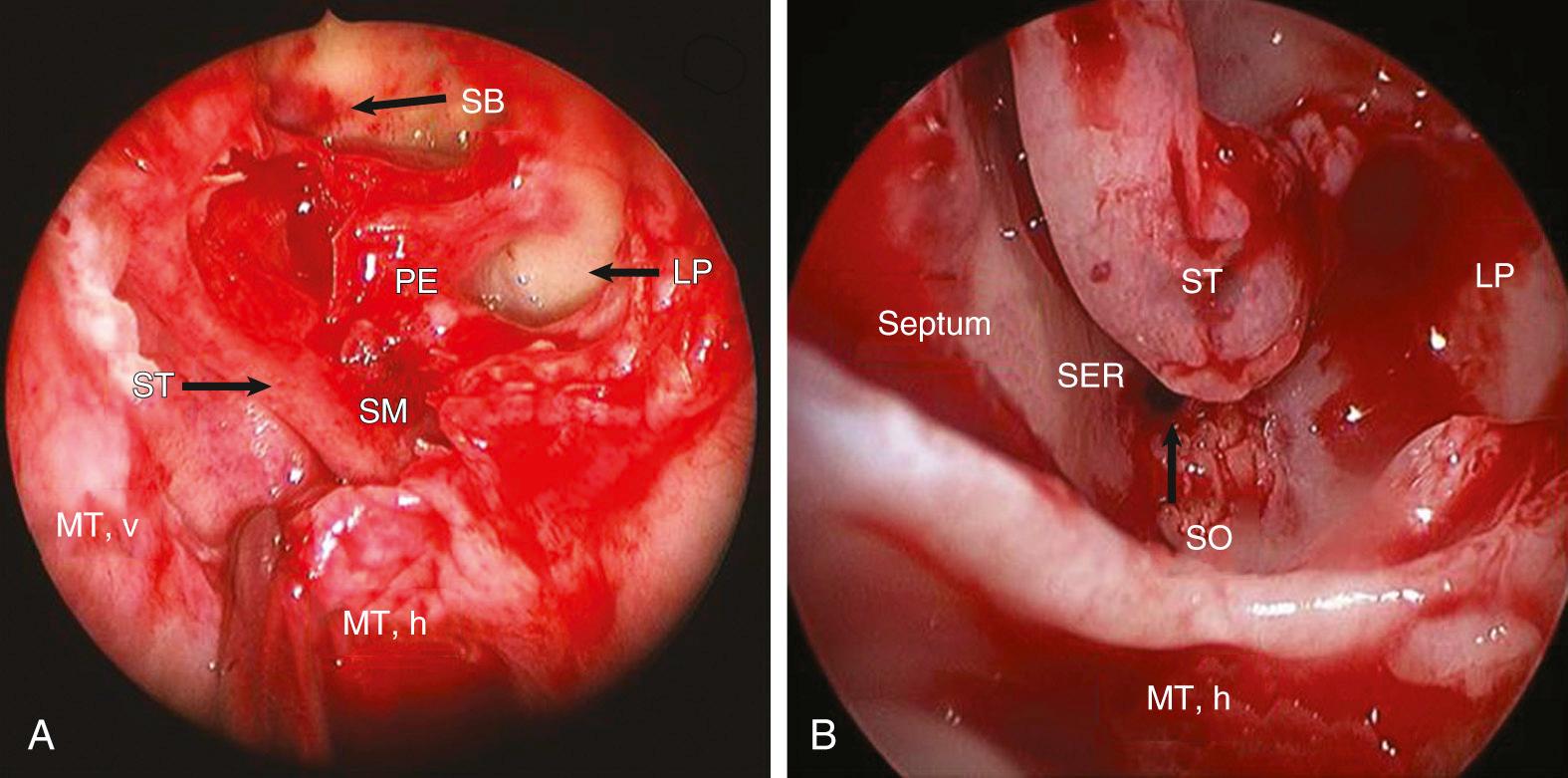 Fig. 44.7, (A) The left superior meatus (SM) has been exposed by dissecting through the oblique basal lamella of the middle turbinate (suction tip). The boundaries of the posterior ethmoidectomy are the superior turbinate (ST) medially, lamina papyracea (LP) laterally, skull base (SB) superiorly, and horizontal attachment of the middle turbinate (MT,h) inferiorly. (B) The sphenoid ostium (SO) drains into the sphenoethmoidal recess (SER) medial to the inferior third of the superior turbinate. The sphenoid ostium is usually located at the junction of the upper one-third and lower two-thirds on the sphenoid face, about 1.5 cm superior to the choana. LP, lamina papyracea; MT,v, middle turbinate, vertical part; MT,h, middle turbinate, horizontal part; PE, posterior ethmoidal cells.