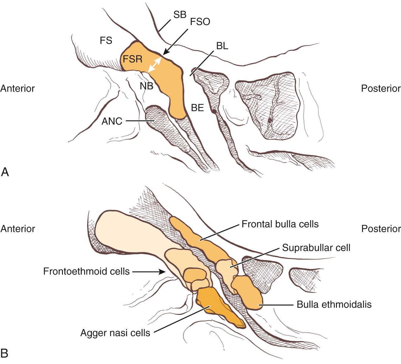 Fig. 44.9, (A) The frontal sinus recess (FSR) is an hourglass-shaped space (shaded area) with the waist at the frontal sinus ostium (FSO) , which is its narrowest part. In the simplest configuration, the boundaries of the frontal recess are limited by the agger nasi cell (ANC) and nasal beak (NB) anteriorly, the bulla ethmoidalis (BE) and the bulla lamella (BL) posteriorly, the anterior skull base (SB) posterosuperiorly, the cribriform plate and middle turbinate medially, and the lamina papyracea laterally. FS, frontal sinus. (B) Frontoethmoidal cells pneumatize around the frontal recess. Frontal cells lie anterior to the frontal recess; suprabullar, supraorbital ethmoidal, and frontobullar cells lie posterior to the frontal recess.