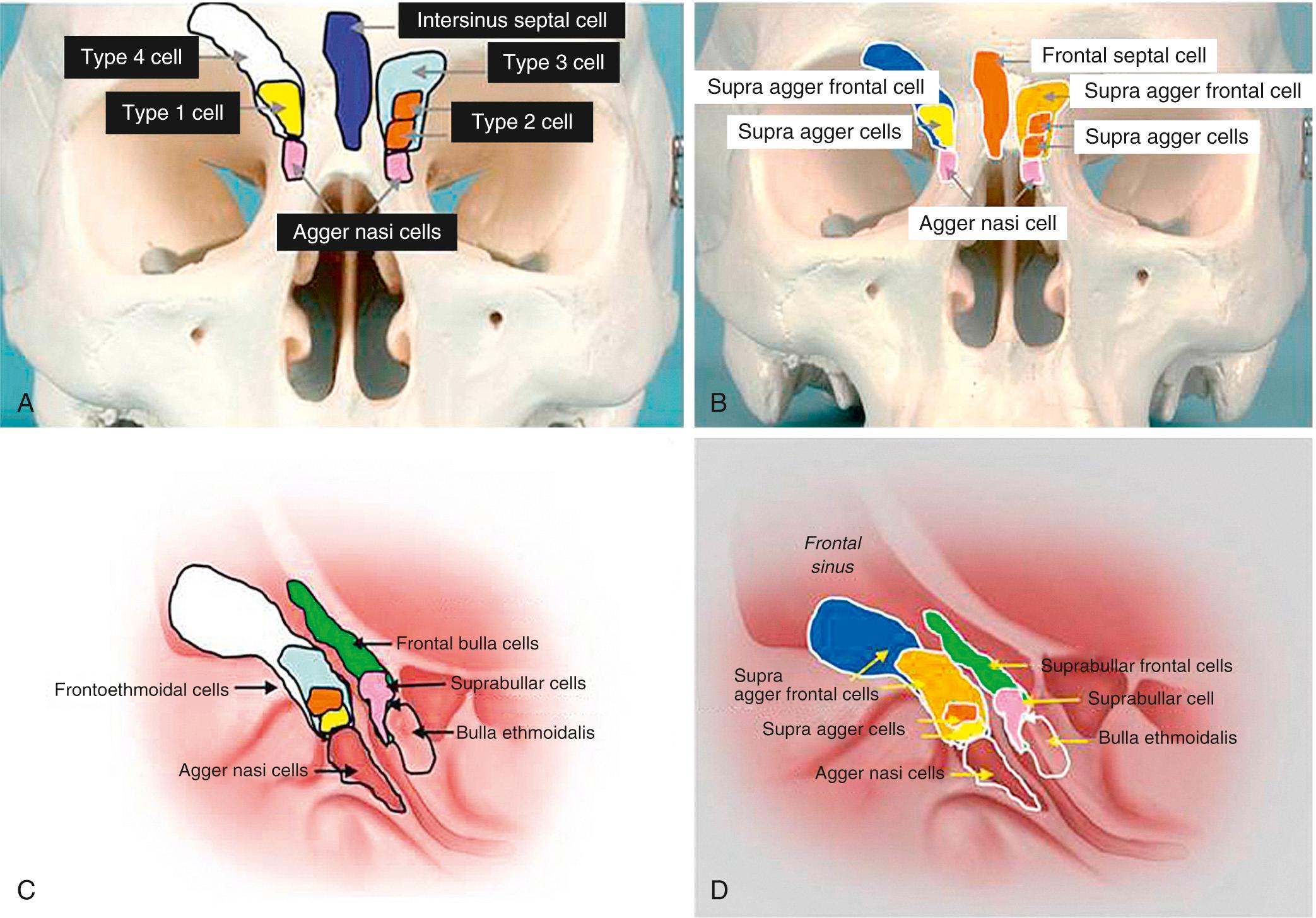 Fig. 44.10, Frontal cells are of four types, depicted here on a skull model (see Box 44.1 for details). (A, C) Kuhn nomenclature 20 ; (B, D) Corresponding new nomenclature according the International Frontal Sinus Anatomy Classification. 23