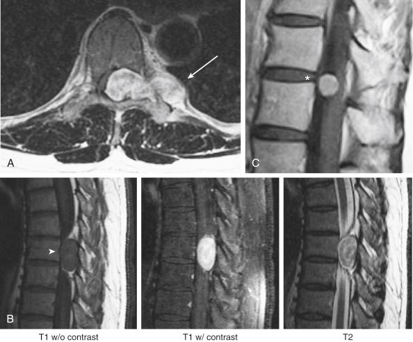 FIGURE 22-1, Examples of intradural extramedullary spinal cord tumors. A, Axial view on T2-weighted magnetic resonance imaging showing a “dumbbell”-shaped schwannoma ( arrow ). B, Schwannoma ( arrowhead ) typically enhances with contrast on T1-weighted imaging and is hyperintense on T2-weighted imaging. w/, with; w/o, without. C, Meningioma ( asterisk ) similarly enhances with contrast on T1-weighted imaging.