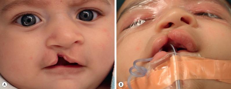 FIG. 3.1.1, A 3-month-old male with a right-sided incomplete cleft lip. (A) There is marked distortion and flattening of the right alar base. “Simonart's band” in the cleft nasal sill is composed of skin but is lacking muscle. (B) Lesser segment maxillary retroposition, outward greater segment alveolar rotation, and nasal deformities are more apparent in the worm's-eye view.