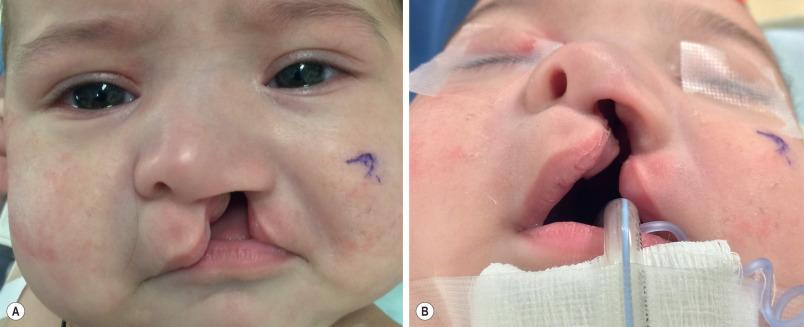 FIG. 3.1.2, A 3-month-old female with a left-sided complete cleft lip. (A) Nasal distortion is more severe than in the infant in Fig. 3.1.1 , and there is greater discrepancy in lip vertical height. (B) Retroposition of the lesser maxillary segment and outward rotation of the greater alveolar segment are more severe and apparent in the worm's-eye view.