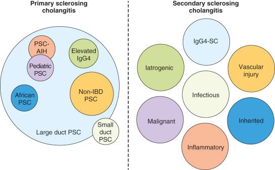 Fig. 43-1, Relationships between subphenotypes of primary sclerosing cholangitis and secondary sclerosing cholangitis.