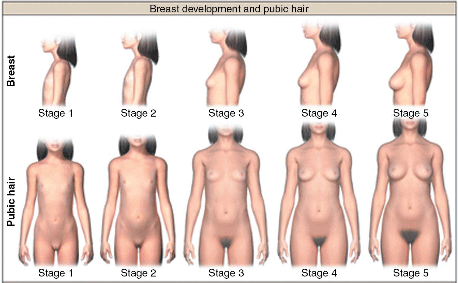 Fig. 36.1, Pubertal rating according to Tanner stage. Top row, Breast development in girls is rated from 1 (prepubertal) to 5 (adult). Stage 2 breast development (appearance of the breast bud) marks the onset of gonadarche. Bottom row, For girls, pubic hair stages are rated from 1 (prepubertal) to 5 (adult). Stage 2 marks the onset of adrenarche.