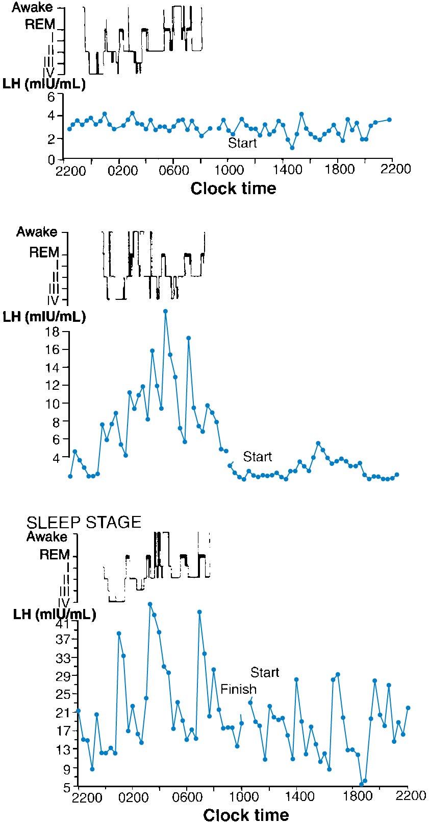 Fig. 36.5, Plasma luteinizing hormone (LH) concentration measured every 20 minutes for 24 hours in normal prepubertal girl (upper panel), early pubertal girl (center panel), and normal late pubertal girl (lower panel). In top and center panels, sleep histogram is shown above period of nocturnal sleep. Sleep stages are awake, rapid eye movement (REM), and stages I to IV by depth of line graph. Plasma LH concentrations are expressed as mIU/mL.