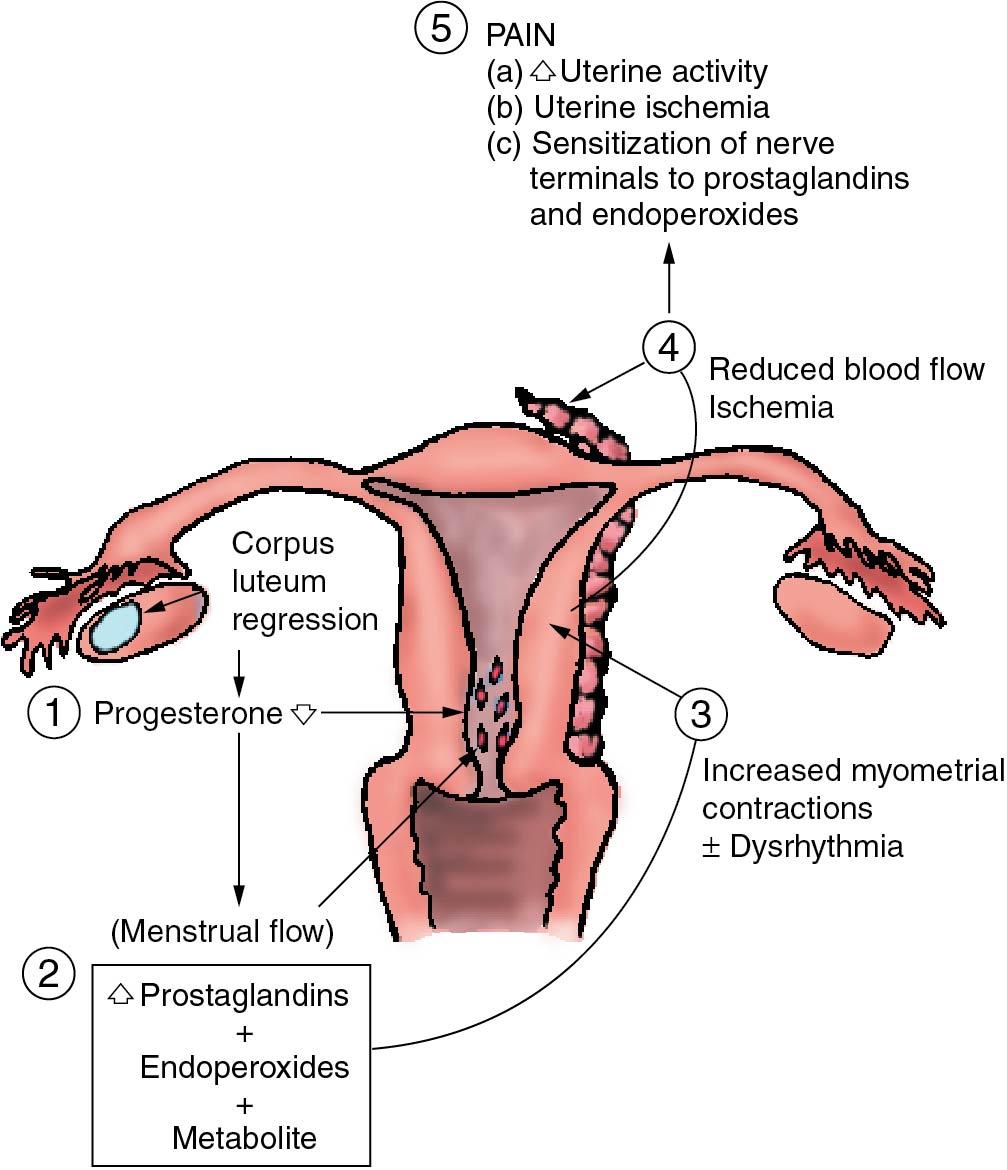 Fig. 35.1, Mechanisms contributing to generation of pain in primary dysmenorrhea.