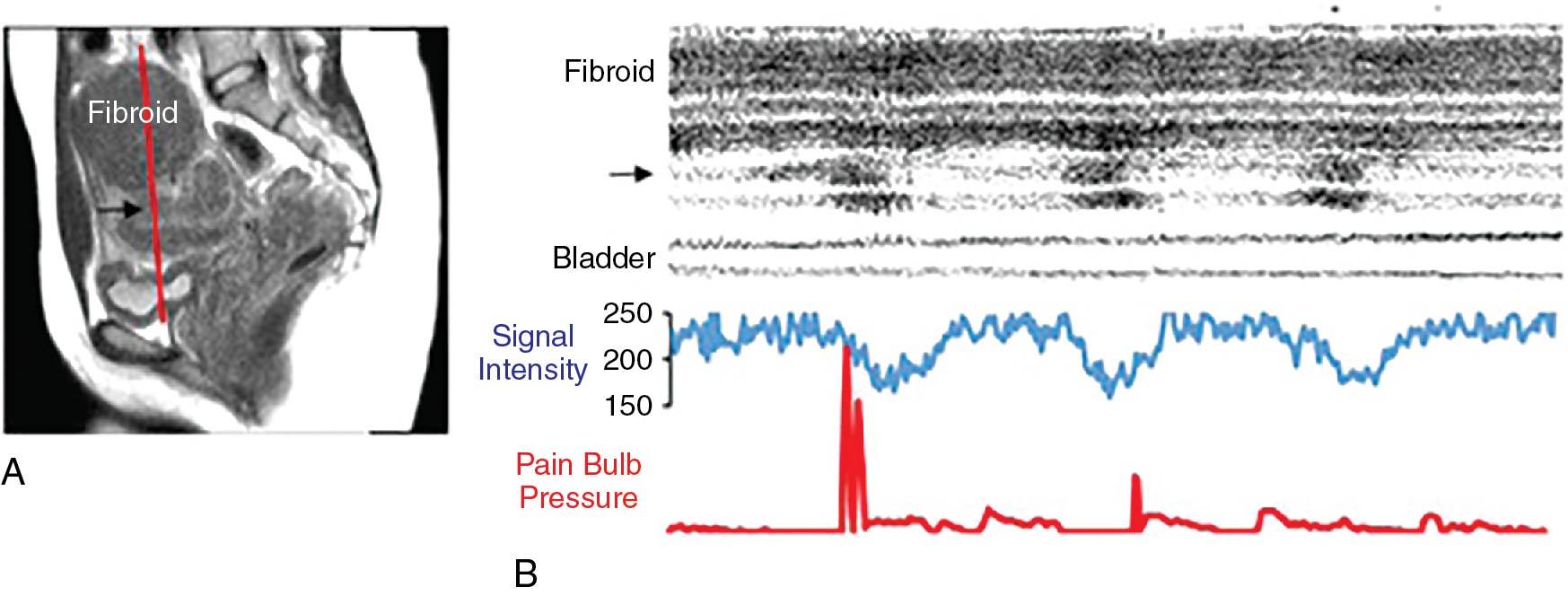 Fig 35.2, Example of measurements of myometrial signal.