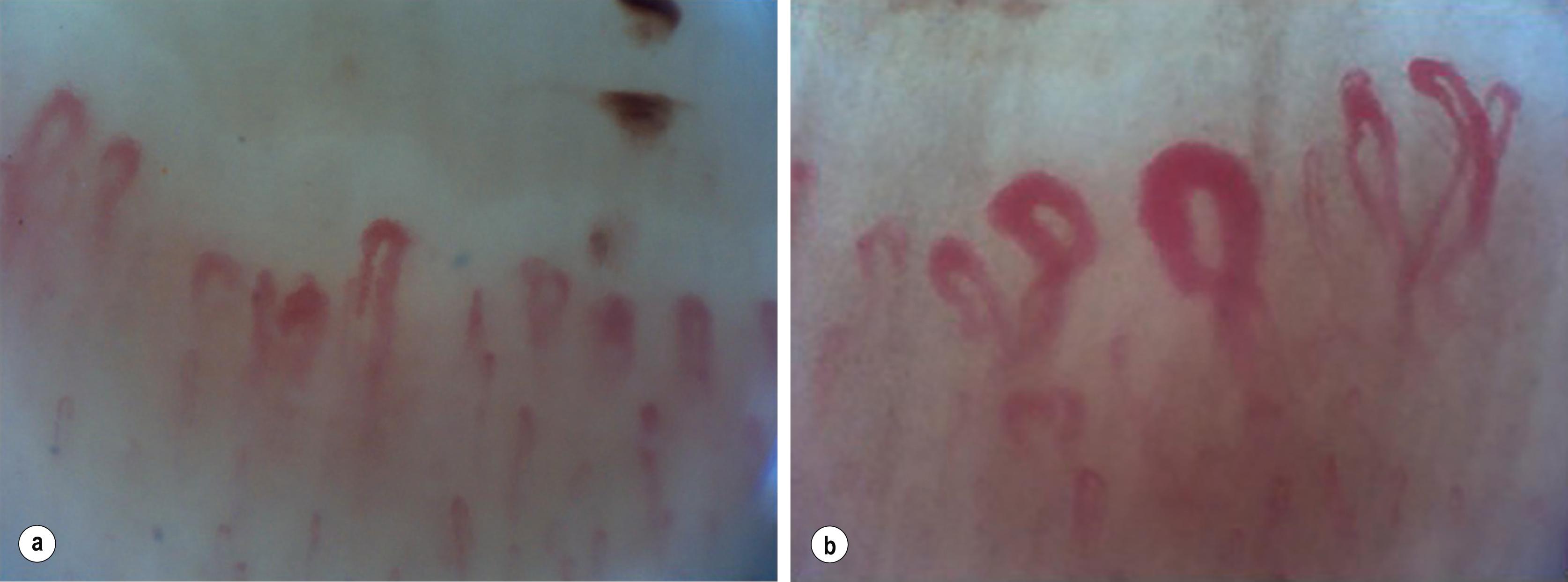 Figure 12.3, Nail-fold capillaroscopy changes in secondary Raynaud’s phenomenon, showing drop out, abnormal architecture, dilated loops and giant forms.