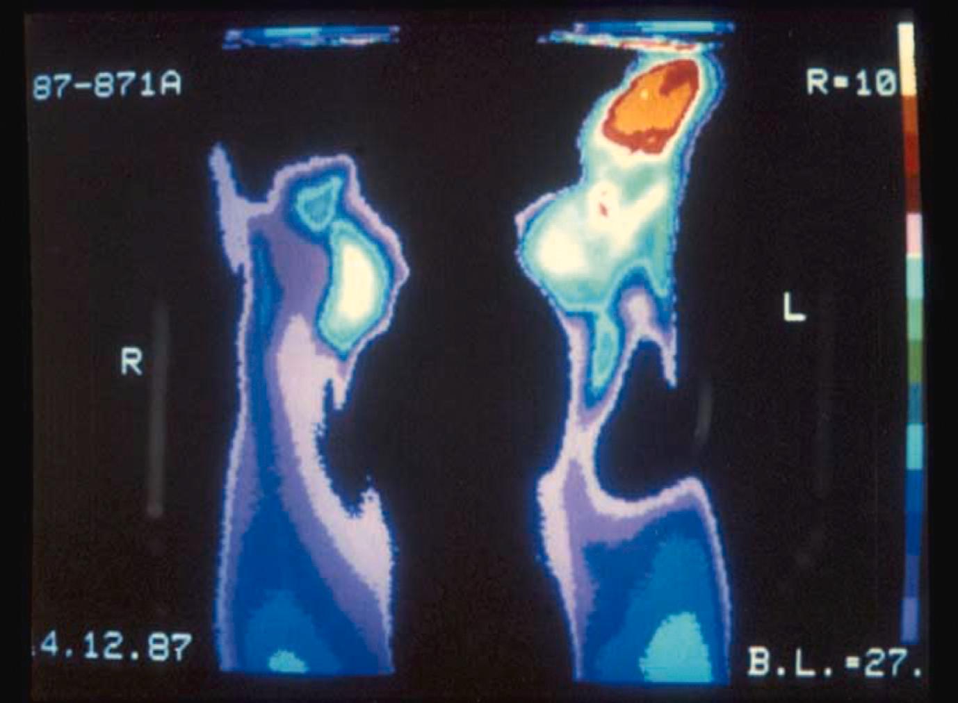 Figure 12.4, Thermography demonstrating Raynaud’s phenomenon of the toes, worse on the right. The image shows a temperature gradient from the mid-foot to the toes on the left (L) and an absence of blood flow to the toes on the right (R), as detected by an infrared camera.