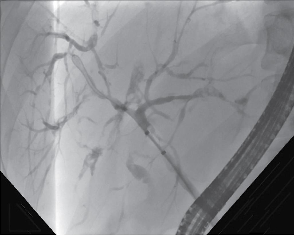 FIGURE 41.1, Endoscopic retrograde cholangiography demonstrating typical cholangiographic findings of primary sclerosing cholangitis, namely diffuse irregularity and multifocal stricturing, with proximal dilation of bile ducts.