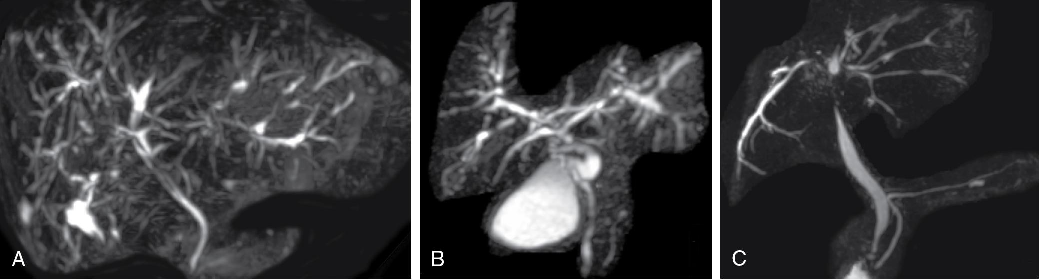 FIGURE 41.2, Magnetic resonance cholangiopancreatography in primary sclerosing cholangitis (PSC).