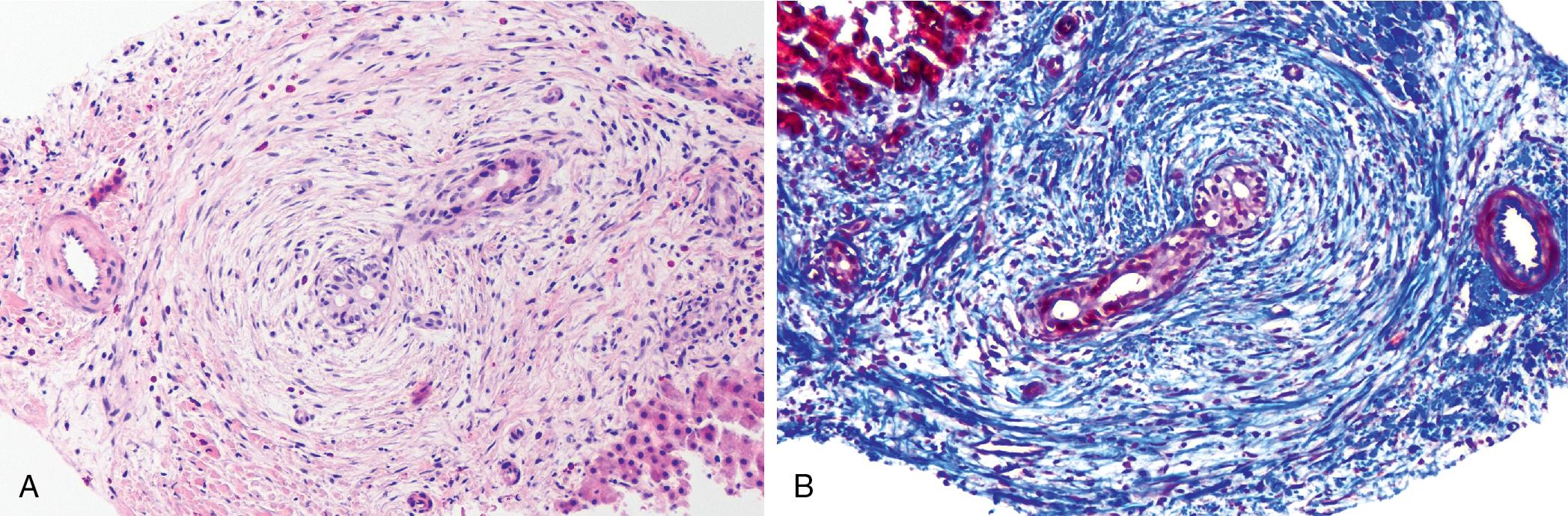 FIGURE 41.3, Histologic features of primary sclerosing cholangitis.