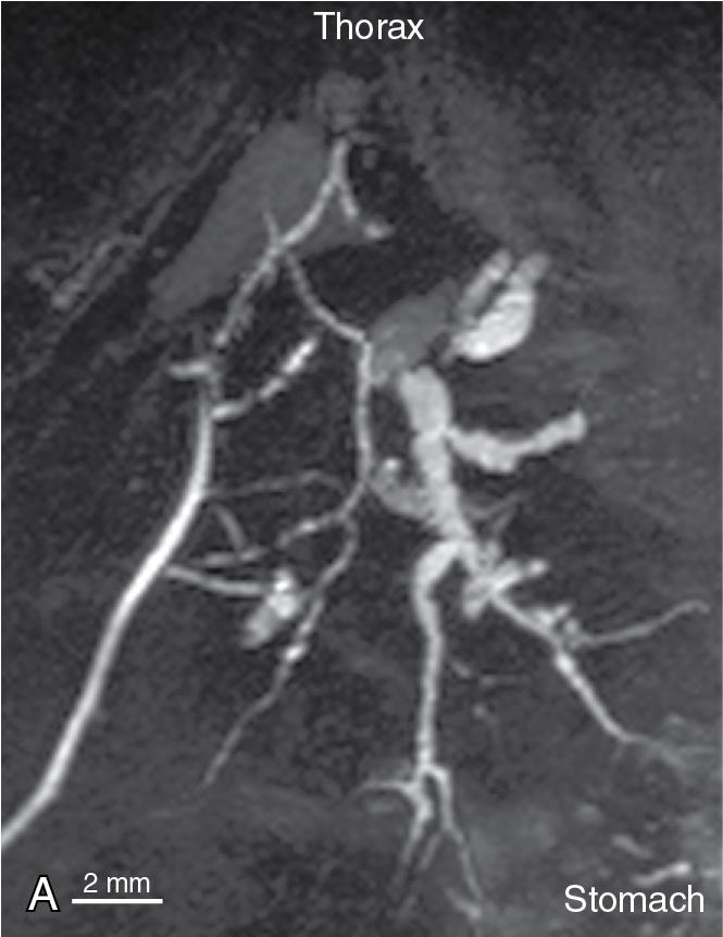 FIGURE 41.4, The multidrug-resistance 2 ( ABCB4 gene) knockout mouse model demonstrates multiple features of primary sclerosing cholangitis. A, Maximal intensity projection of a live adult ABCB4 gene knockout mouse by using a 16.4-tesla small animal magnetic resonance imaging spectrometer exhibiting characteristic biliary ductal irregularity. B, Histologic appearance of the liver with features of biliary fibrosis.