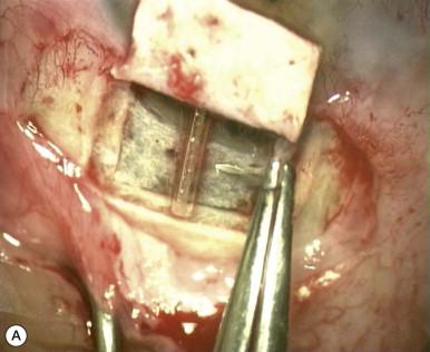 Figure 96-2, Implants. (A) The collagen implant was placed radially and secured with a single 10-0 nylon suture. (B) Reticulated hyaluronic acid implant. (C) Autologous scleral implant secured underneath the scleral flap. (D) Flat collagen implant.