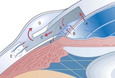 Figure 96-3, Schematic representation of viscocanalostomy with the possible aqueous humor routes after the surgery: (A) the Descemet's window; (B) the ruptures of Schlemm's canal walls and trabecular meshwork; (C) the intrascleral space; (D) the episcleral veins via a dilated Schlemm's canal; (E) the new aqueous veins in the intrascleral space; (F) the suprachoroidal space; (G) the subconjunctival filtering bleb. The arrows represent the probable directions of the outflow.