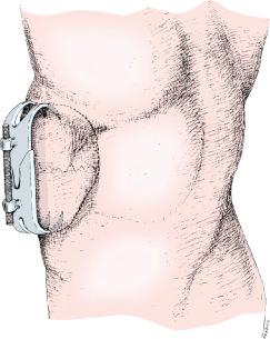 Fig. 8.1, Malgaigne's 1846 external fixator for patellar fractures.