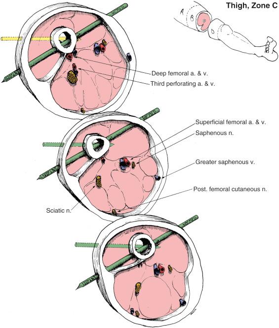 Fig. 8.11, Thigh Zone C. Anatomic Considerations.