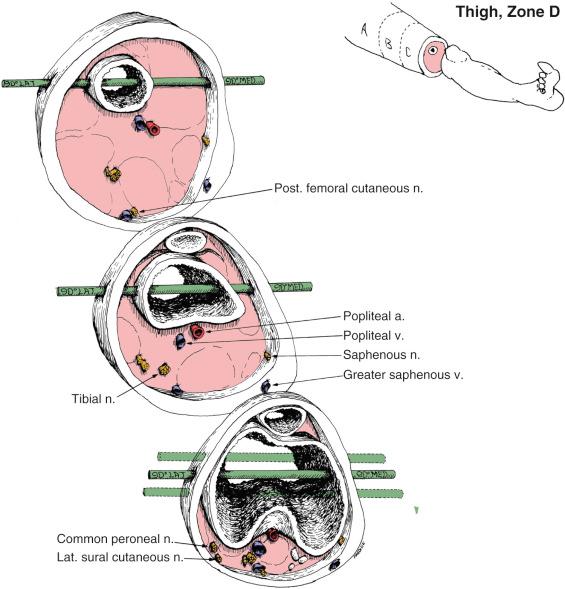 Fig. 8.12, Thigh Zone D. Anatomic Considerations.