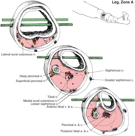 Fig. 8.13, Leg, Zone A. Anatomic Considerations.