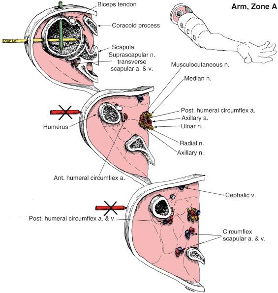 Fig. 8.18, Arm, Zone A. Anatomic Considerations.