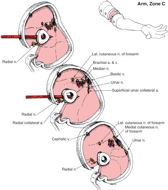 Fig. 8.20, Arm, Zone C. Anatomic Considerations.