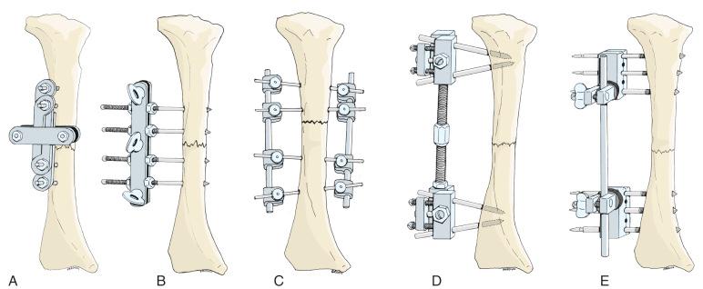 Fig. 8.2, Historic external fixators. (A) Parkhill bone clamp. (B) Lambotte fixator. (C) Anderson apparatus. (D) Stader apparatus. (E) Hoffmann fixator.