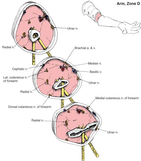 Fig. 8.21, Arm, Zone D. Anatomic Considerations.