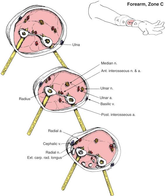 Fig. 8.24, Forearm, Zone C. Anatomic Considerations