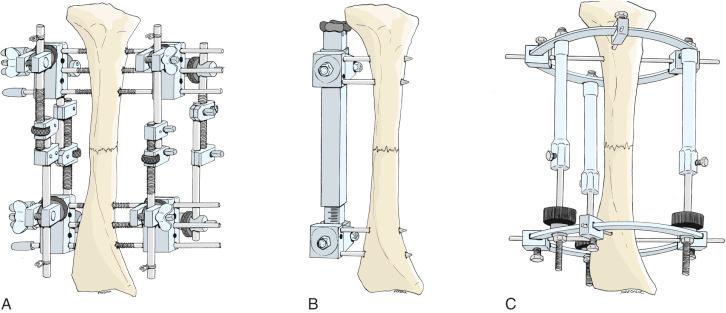 Fig. 8.3, Modern external fixators. (A) Vidal quadrilateral frame. (B) Wagner limb lengthener. (C) Ilizarov apparatus.