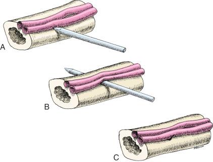 Fig. 8.6, (A) A pin or wire directed at a vessel will often push the structure to the side. (B) A vessel resting on an implant may erode and bleed 2 or more weeks after implant insertion. (C) Alternatively, bleeding may occur at the time of implant removal.