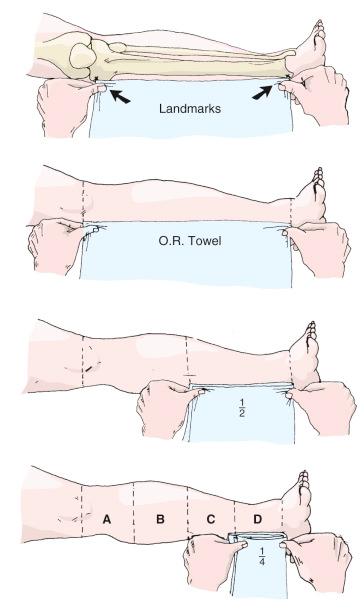 Fig. 8.8, To mark the zones, stretch a surgical towel between the proximal and distal landmarks described in the text and mark the position of the landmarks on the towel with a surgical pen. Fold the towel so that the marks touch each other and mark the midpoint of the fold. Lay the towel against the limb again and mark the midpoint on the limb using the towel as a guide. In this manner, the limb section will be divided in half. Repeat the procedure and find the midpoint of each half, thus dividing the limb segment into four equal zones.