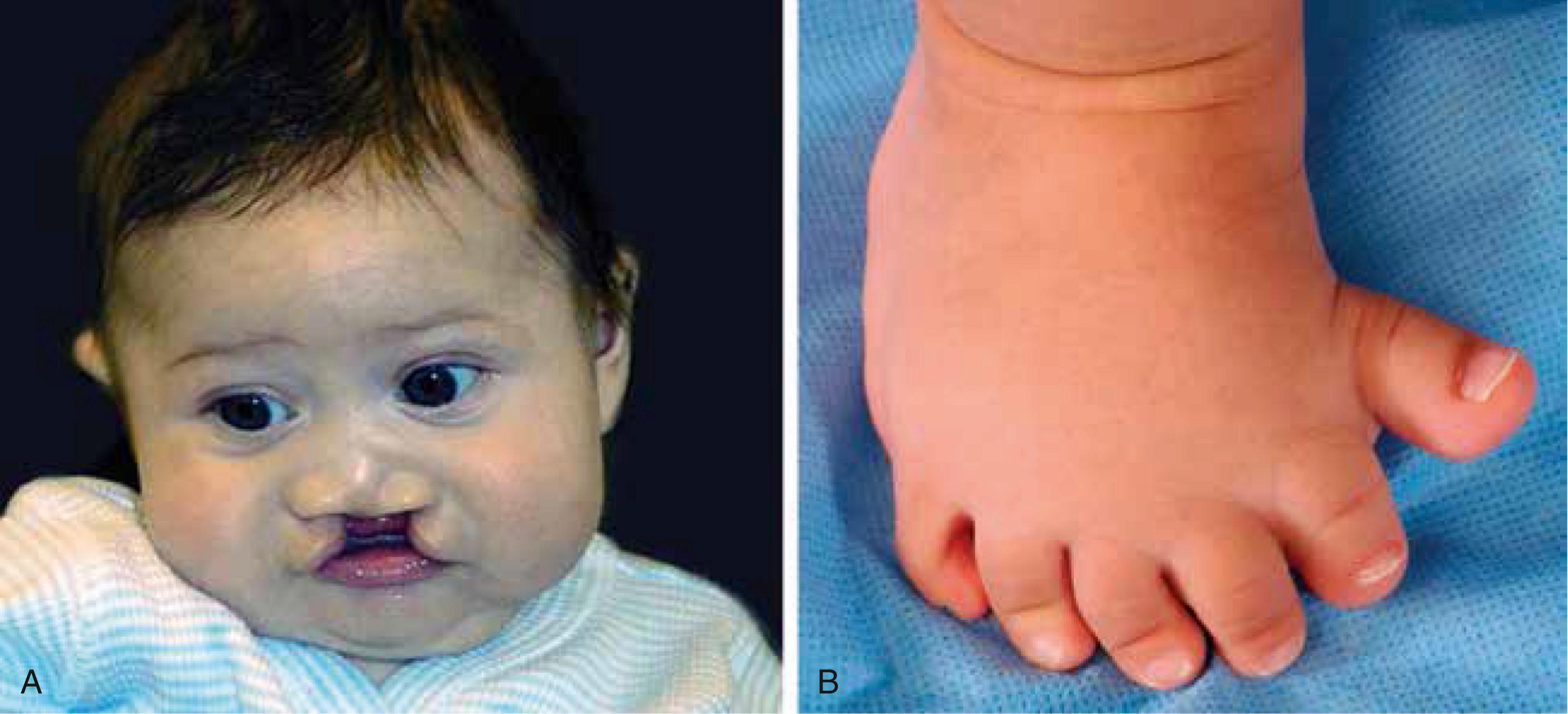 Fig. 5.1, Mutations in the SONIC HEDGEHOG (SHH) Gene Have Multiple Manifestations