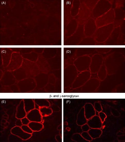 Figure 51.3, Neuronal nitric oxide synthase and sarcoglycans confirm dystrophin expression. ( A ) Neuronal nitric oxide synthase (nNOS) shows no staining in muscle from a DMD patient with deletion in exon 52. ( B , D ) Restoration of nNOS binding site following eteplirsen treatment from patient 6 at week 48. ( C ) Normal muscle showing nNOS expression (no treatment). ( E ) β-Sarcoglycan and ( F ) γ-sarcoglycan staining at week 48 (patient 6), demonstrating restoration of the sarcoglycan complex with eteplirsen.