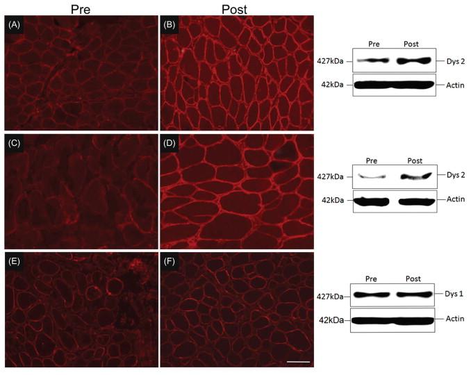 Figure 51.5, Dystrophin expression following gentamicin treatment. Pre- and post-gentamicin treatment muscle biopsies demonstrating dystrophin expression by immunofluorescence (IF) using DYS 2 Novacastra and Western blot (WB). ( A , B ) Pre- and post-treatment IF muscle biopsy sections (patient 6) stained with DYS2 antibody; adjacent WB shows full-length dystrophin at 427 kDa. Gentamicin–induced dystrophin expression to 15.44%. ( C , D ) Pre- and post-treatment muscle biopsy (patient 10) IF sections stained with DYS2 antibody; adjacent WB shows full-length dystrophin at 427 kDa. Gentamicin-induced dystrophin increased to 13.0%. ( E , F ) Pre- and post-treatment muscle biopsy sections from patient 5 without response to gentamicin showing negligible increase after treatment by IF and WB. Scale bar=100 μm.