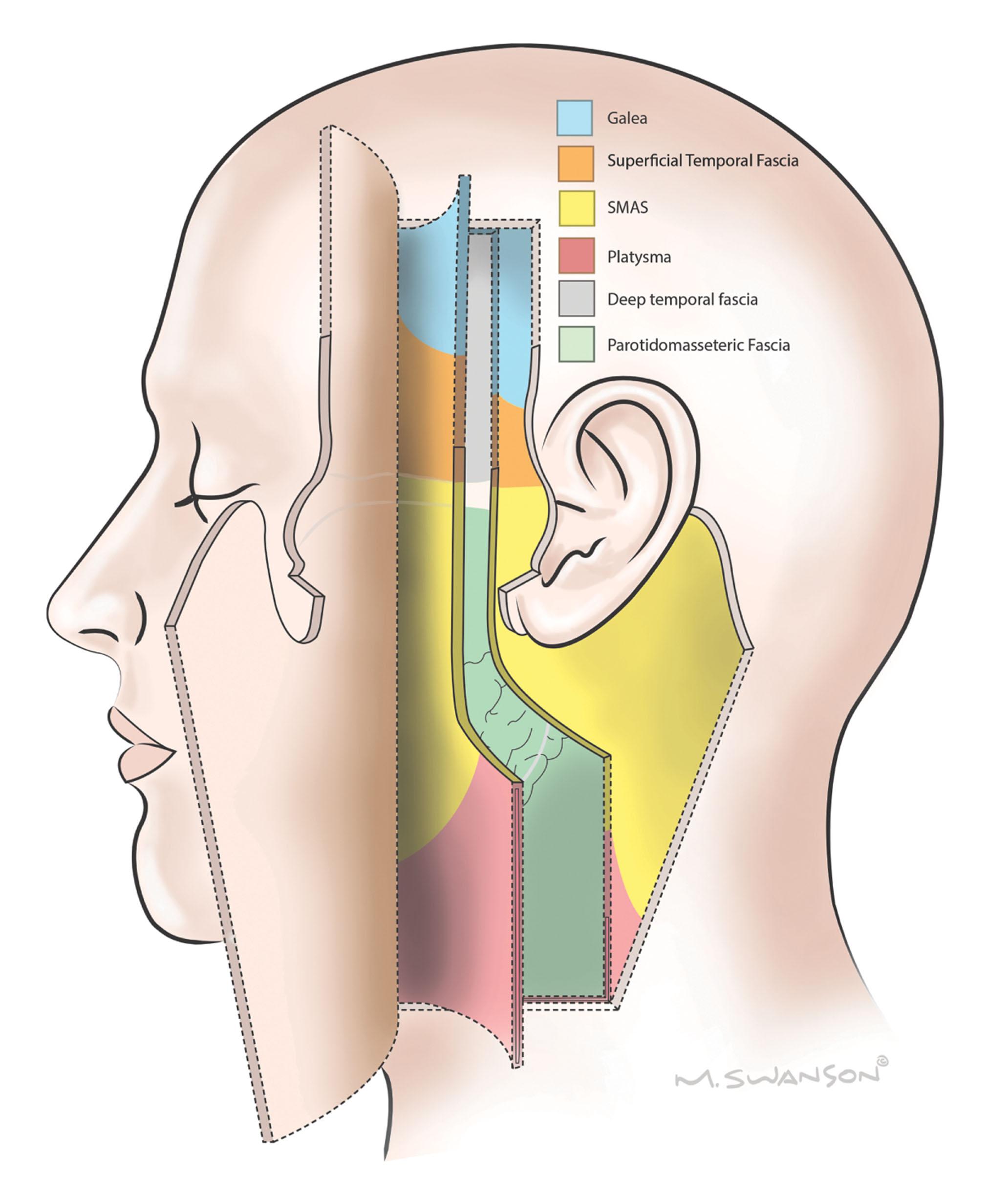Figure 9.3.2, The face is composed of concentric layers of soft tissue. The most superficial layer is skin and subcutaneous fat – elevated in this image. Next is the superficial musculo-aponeurotic system (SMAS) , which is contiguous with the platysma inferiorly and with the superficial temporal fascia (temporoparietal fascia) and galea superiorly. Deep to the superficial fascia is the parotidomasseteric fascia, contiguous with the deep cervical fascia inferiorly and the deep temporal fascia superiorly.