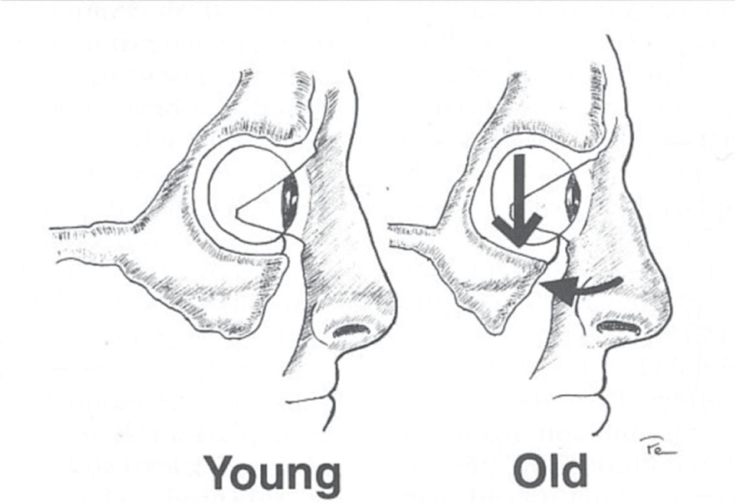 Figure 9.3.10, Computed tomography of young and old skulls has demonstrated a retrusion of the infraorbital rim.