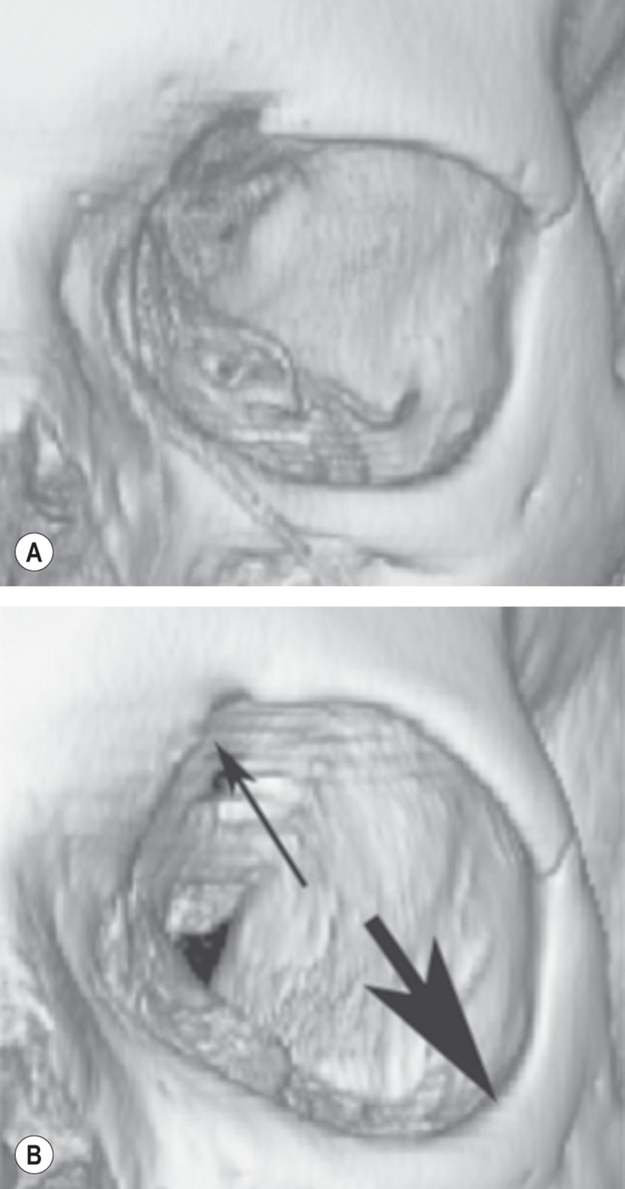 Figure 9.3.11, Computed tomography scans of (A) a male patient in the younger age group and (B) a male patient in the older age group. The image from the older age group shows significant bony remodeling (arrows) both superomedially and inferolaterally.