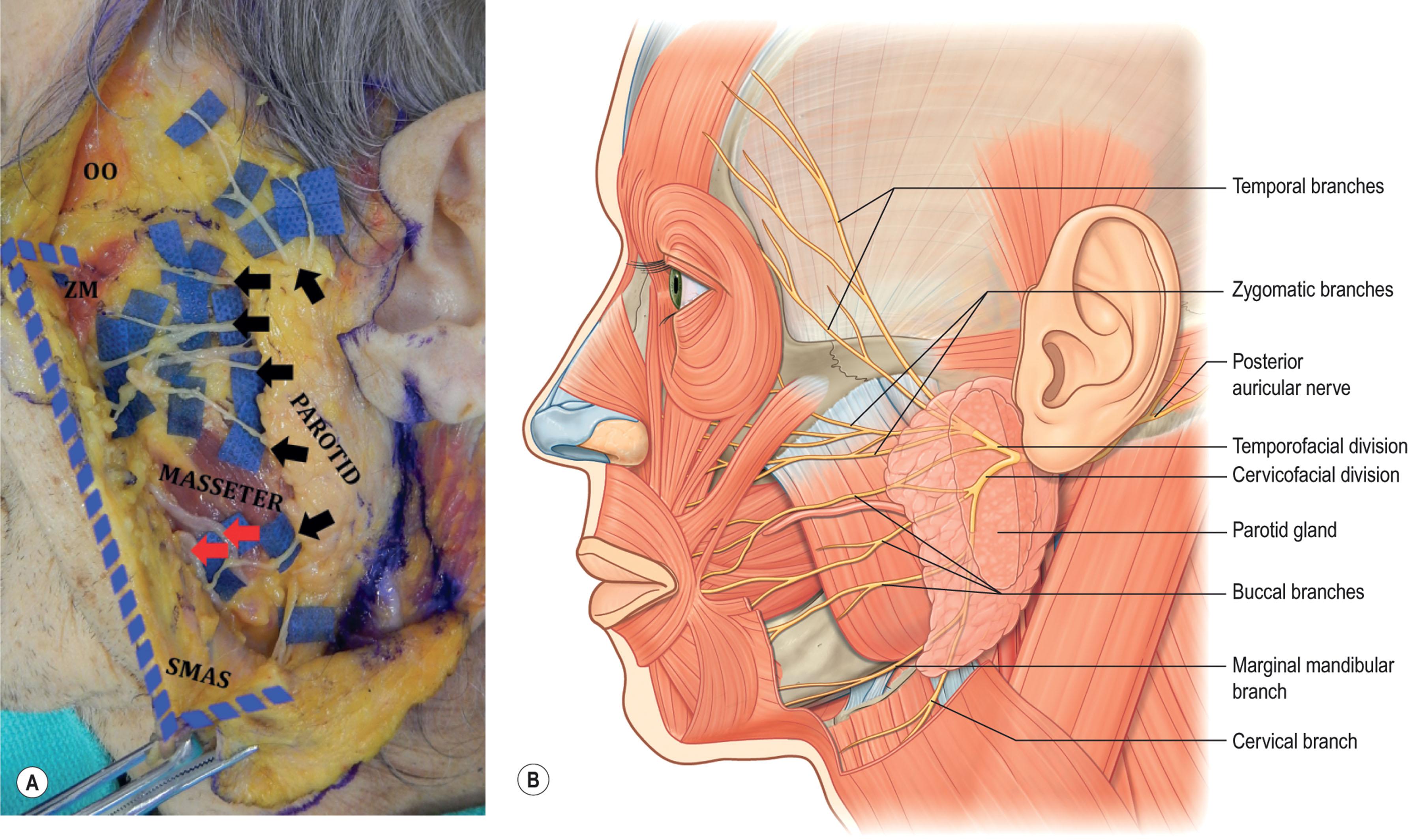 Figure 9.3.12, (A) A cadaveric dissection of the facial nerve. The skin has been reflected anteriorly. The superficial musculo-aponeurotic system (SMAS) has been elevated, held with clamps and the cut edge is highlighted with blue dashes. The facial nerve branches emerge from the parotid gland; they are identified by black arrows and are highlighted by blue background. OO, Orbicularis oculi; ZM, zygomaticus major. (B) Diagram of the facial nerve. The facial nerve exits the stylomastoid foramen and normally divides within the parotid gland into a superior and inferior division. Classically, five groups of branches are seen: temporal, zygomatic, buccal, mandibular, and cervical. There is arborization between branches, particularly between the zygomatic and buccal branches.