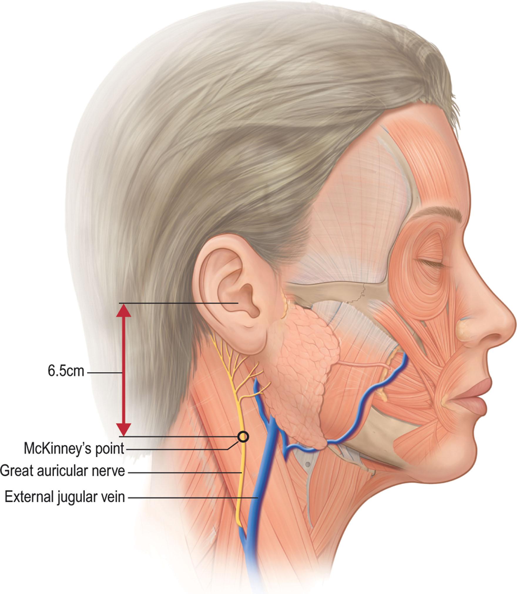 Figure 9.3.13, The great auricular nerve crosses the midportion of the sternocleidomastoid (SCM) at McKinney's point, which is 6.5 cm inferior to the external auditory canal. It usually travels about 1 cm posterior to the external jugular vein. Anterior to McKinney's point, the nerve is covered by the superficial cervical fascia and the platysma (SMAS), but at the posterior border of the SCM, the nerve is effectively subcutaneous. The most common point of injury is at the posterior border of the SCM muscle.