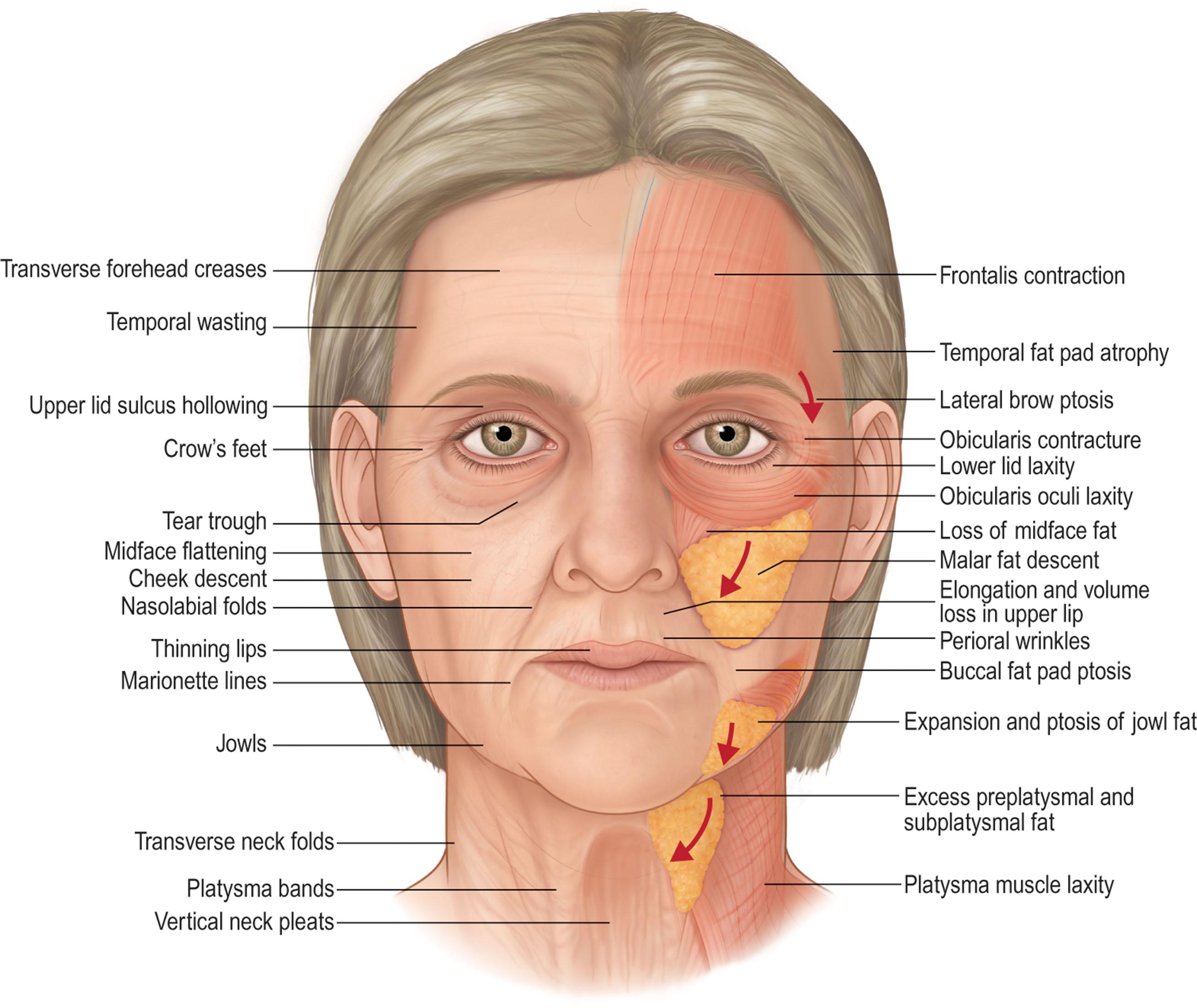 Figure 9.3.1, The aging face exhibits changes in the skin including superficial wrinkles and deeper folds. There is ptosis of soft tissue, particularly in the cheek, along the jawline and in the neck. There is loss of volume in areas such as the temple, the upper cheek, the midcheek and the premaxilla.