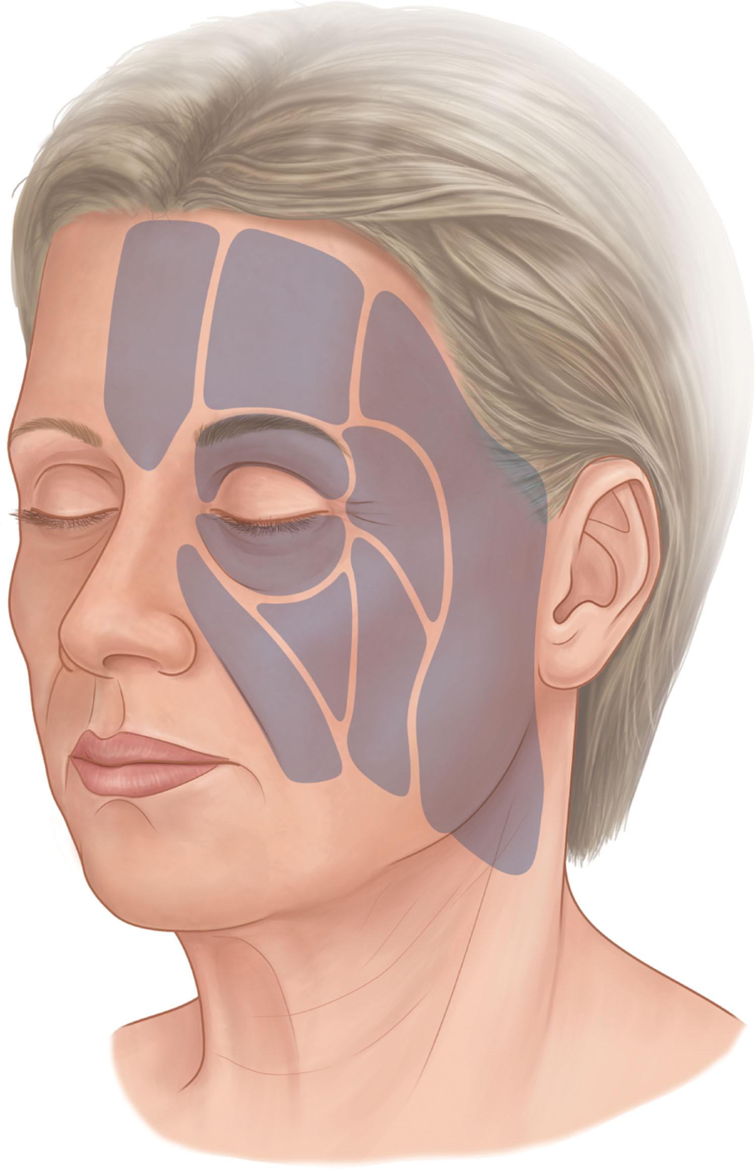 Figure 9.3.5, Superficial facial fat is compartmentalized by vertically running septae. In the midcheek, from medial to lateral, these compartments are the nasolabial, medial, middle, and lateral compartments. The nasolabial and medial compartments make up the malar fat pad.