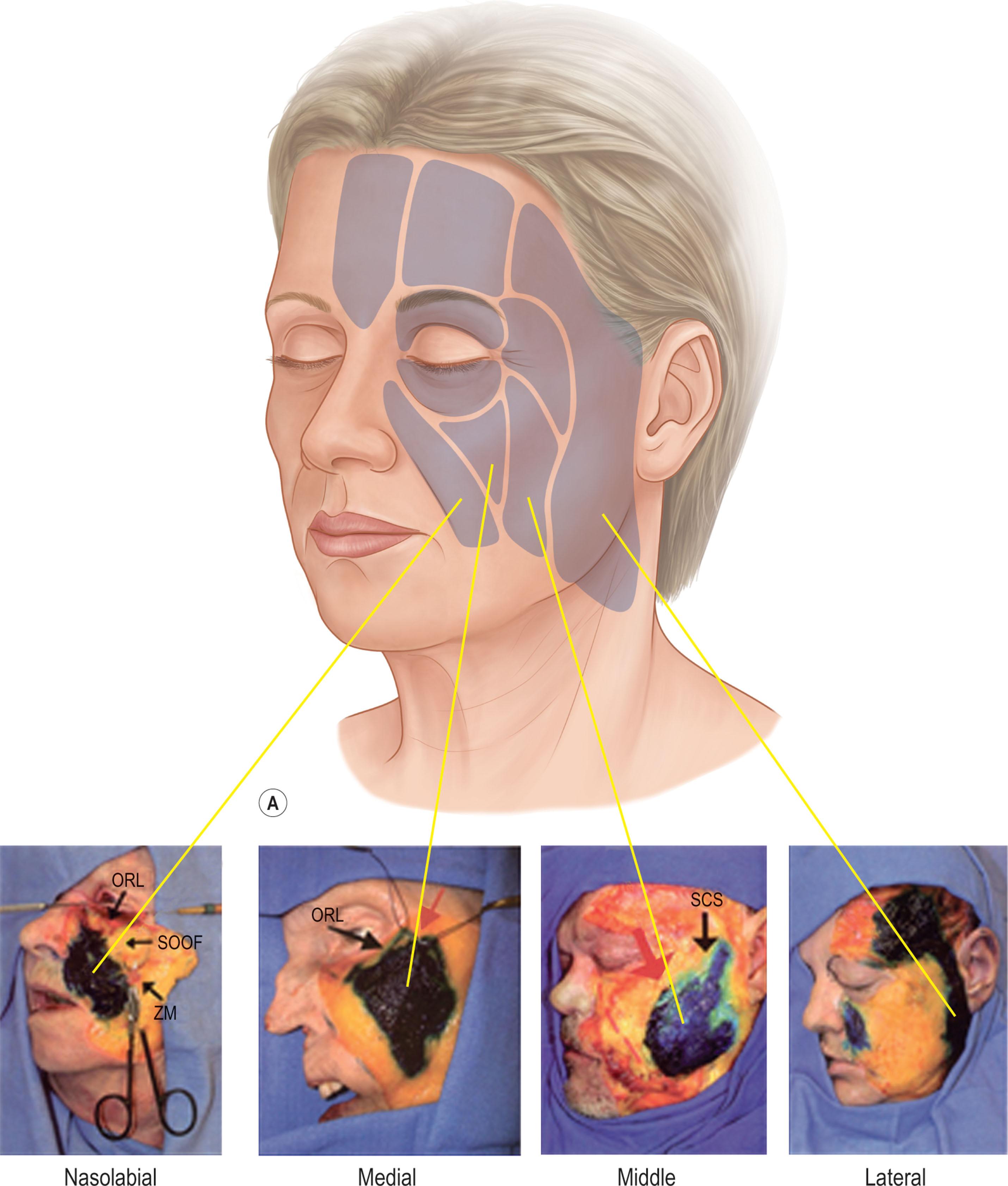 Figure 9.3.5, Superficial facial fat is compartmentalized by vertically running septae. In the midcheek, from medial to lateral, these compartments are the nasolabial, medial, middle, and lateral compartments. The nasolabial and medial compartments make up the malar fat pad.