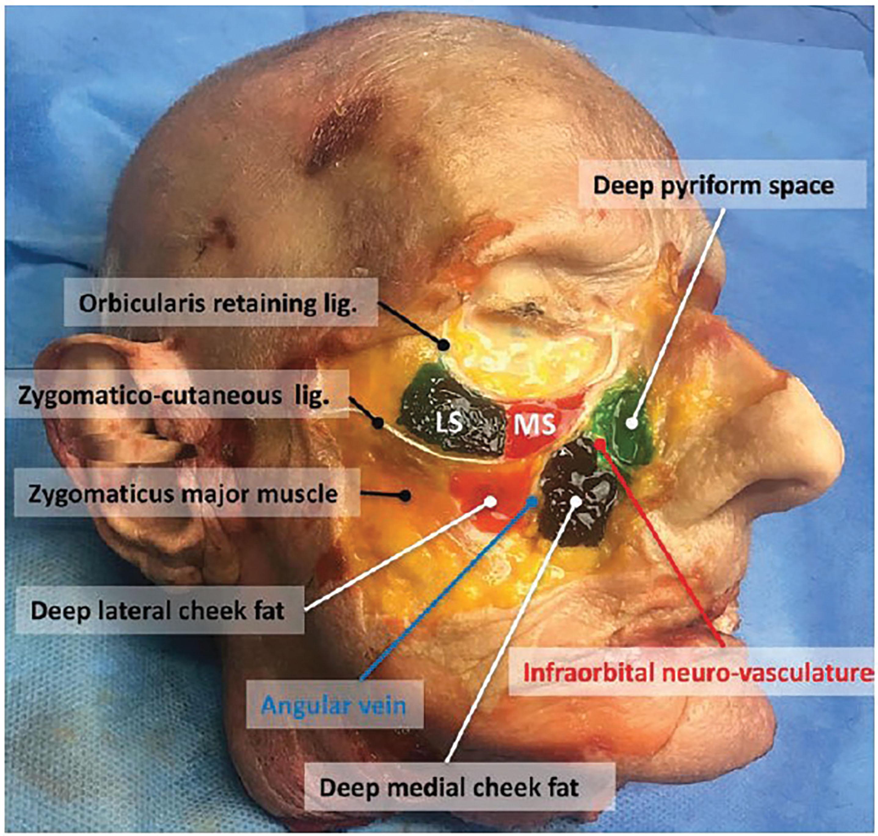 Figure 9.3.6, The deep facial fat is compartmentalized by septae. In this cadaveric dissection the levator labii superioris has been removed to expose the deep fat compartments. From medial to lateral, the deep fat compartments are the deep pyriform space, the deep medial fat compartment and the lateral fat compartment. White lines indicate the zygomaticocutaneous ligament and the orbicularis retaining ligament (ORL). Above the ORL are the medial (MS) and lateral (LS) components of the suborbicularis oculi fat.