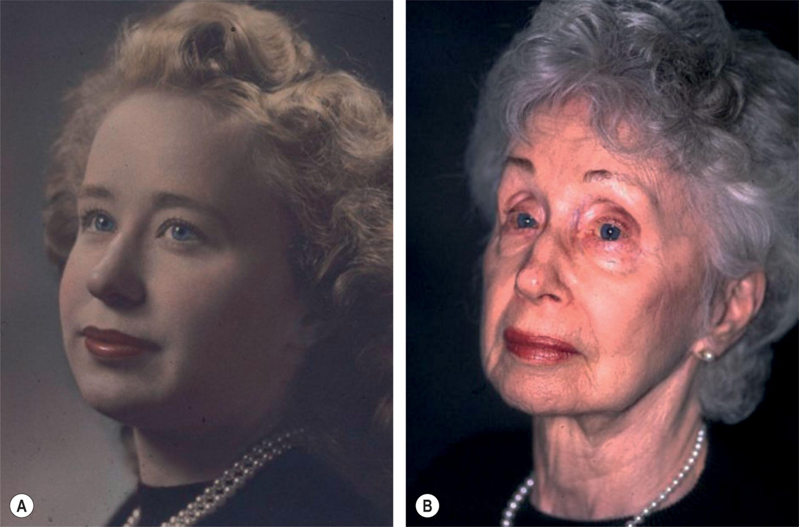 Figure 9.3.7, This healthy 75-year-old woman has never undergone facial surgery, has gained 10 pounds, but has aged 50 years. She has lost fat in the periorbital region and middle third of her face, revealing underlying bone. The orbit seems to have enlarged. Overall volume has been lost in the middle third of the face. The soft tissues that remain appear to be ptotic, flattening her cheeks, and widening her jawline. The heart-shaped face of youth has become more rectangular.