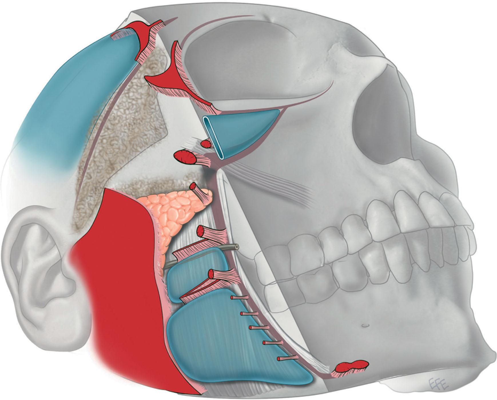 Figure 9.3.9, Mendelson's interpretation of soft-tissue attachments (see Chapter 9.2 ). The fixed posterior soft tissue is held in place by the platysma auricular fascia (large red area). The anterior face is fixed by a vertical column of attachments: orbital ligament, lateral orbital thickening (superficial canthal tendon), zygomatic ligaments, masseteric ligaments, mandibular ligament). In the midcheek, there is some mobility of these ligaments, while there is limited mobility over the platysma auricular fascia. The so-called “fixed SMAS” is that portion attached to the parotid and the posterior border of the platysma. Anterior to this, is the “mobile SMAS”. (Courtesy of Dr. Levent Efe, CMI.)