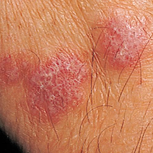 Lichen planus