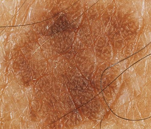 Seborrheic keratosis